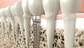 implanty zębowe warszawa