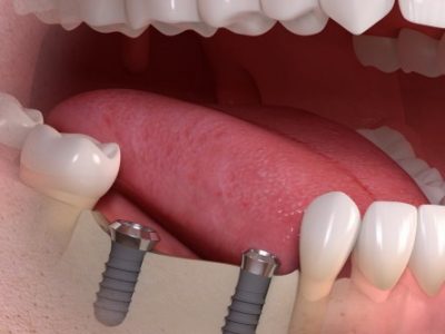 implanty zębowe warszawa