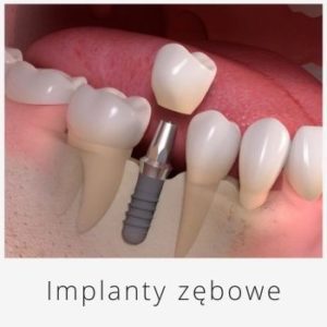 implanty zebowe, implanty zebow